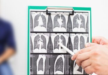 longfibrose en roken