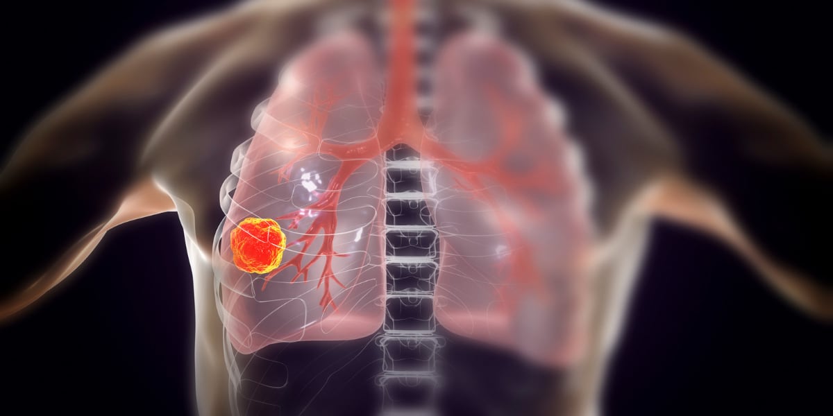 Diagnose Kanker maar toch blijven roken